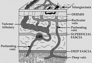 varicose vein
