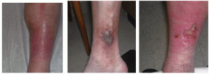 varicose veins